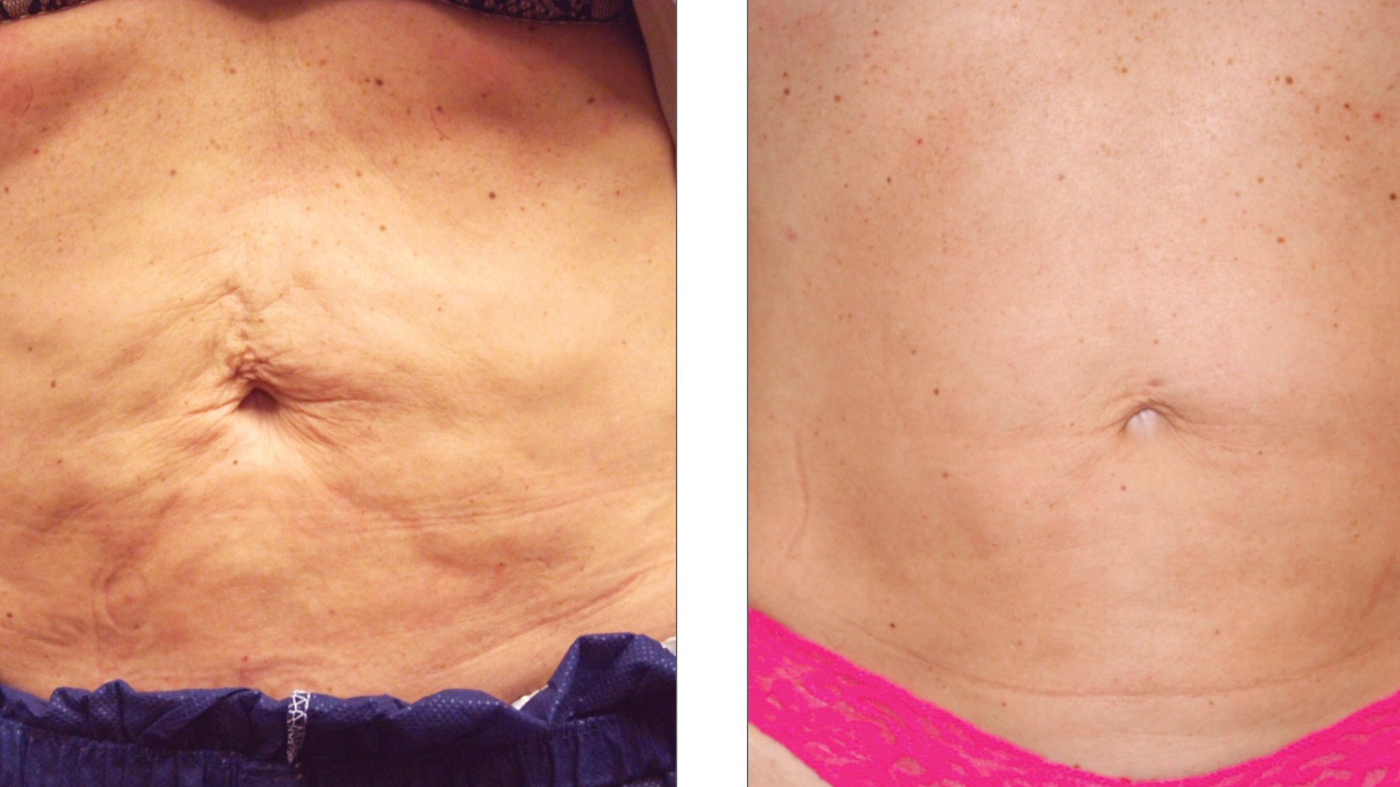 VFRPL_ClinicalCaseBook_LowcountryPlasticSurgery_Abdomen_3Tx trattamento corpo programma anticellulite innovativo